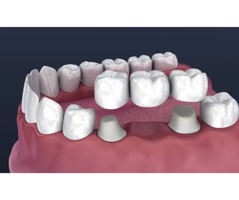 Dental bridge model spanning the gap left by a missing tooth