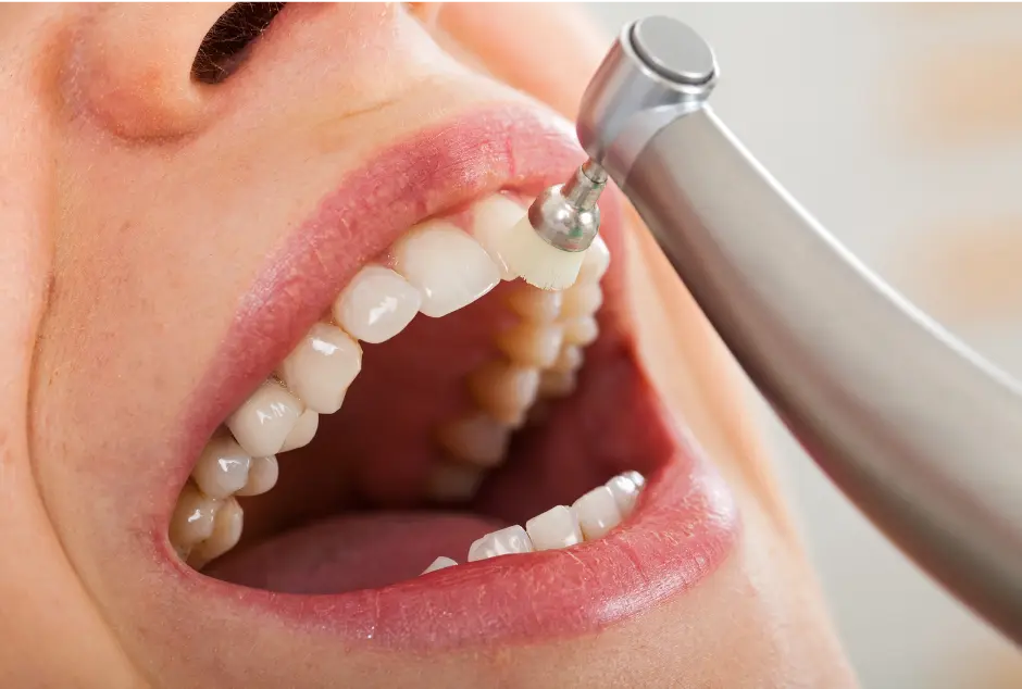 Dental hygienist performing a professional teeth cleaning at Valley Dental Turlock