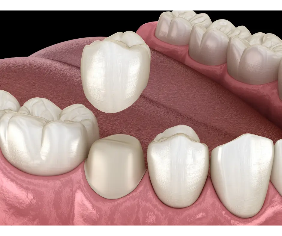 How to Know If You Need a Dental Crown or Filling
