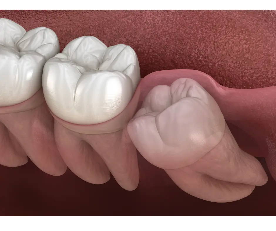 Extractions at Valley Dental Turlock