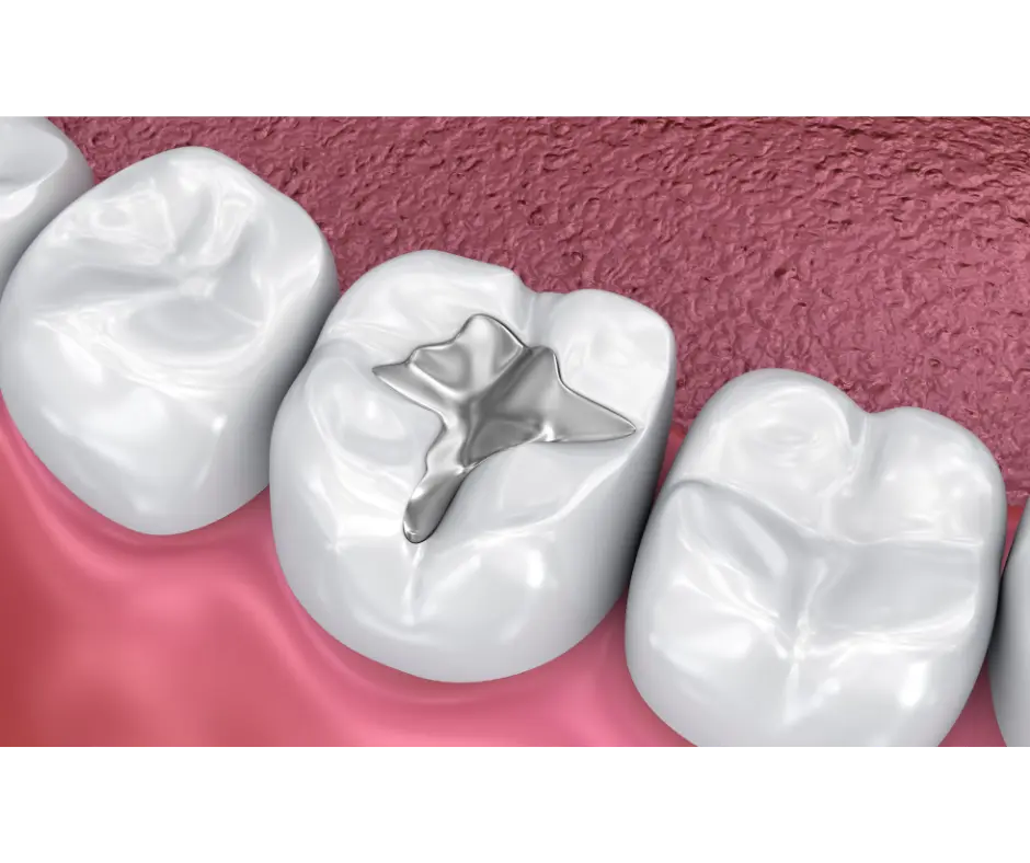 Tooth-colored dental filling treatment at Valley Dental Turlock
