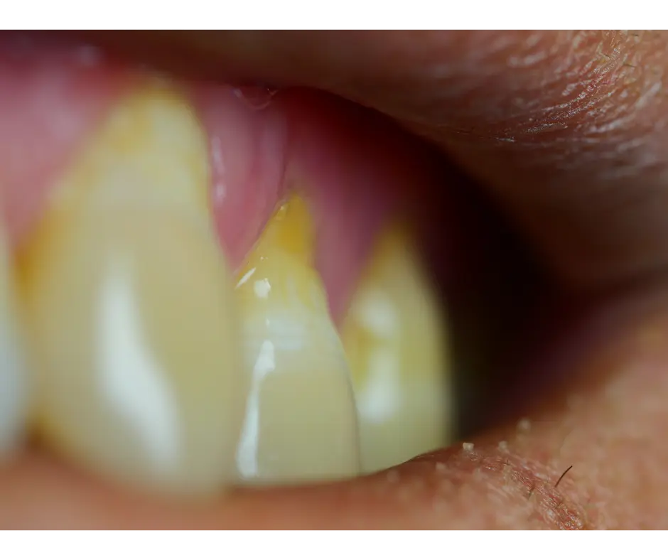 Periodontal gum disease examination at Valley Dental Turlock