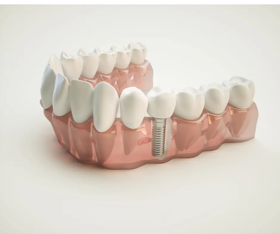 Dental implant with crown attached, replacing a single missing tooth
