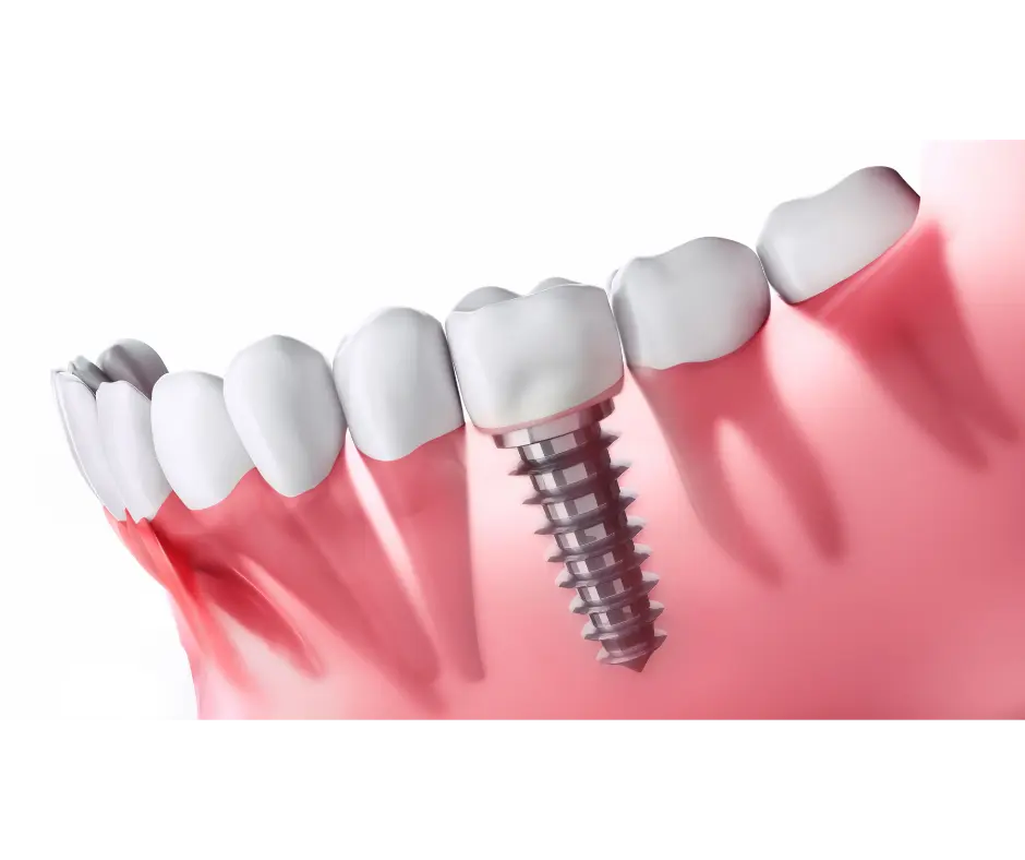 What’s the Best Way to Replace a Missing Tooth in Turlock?