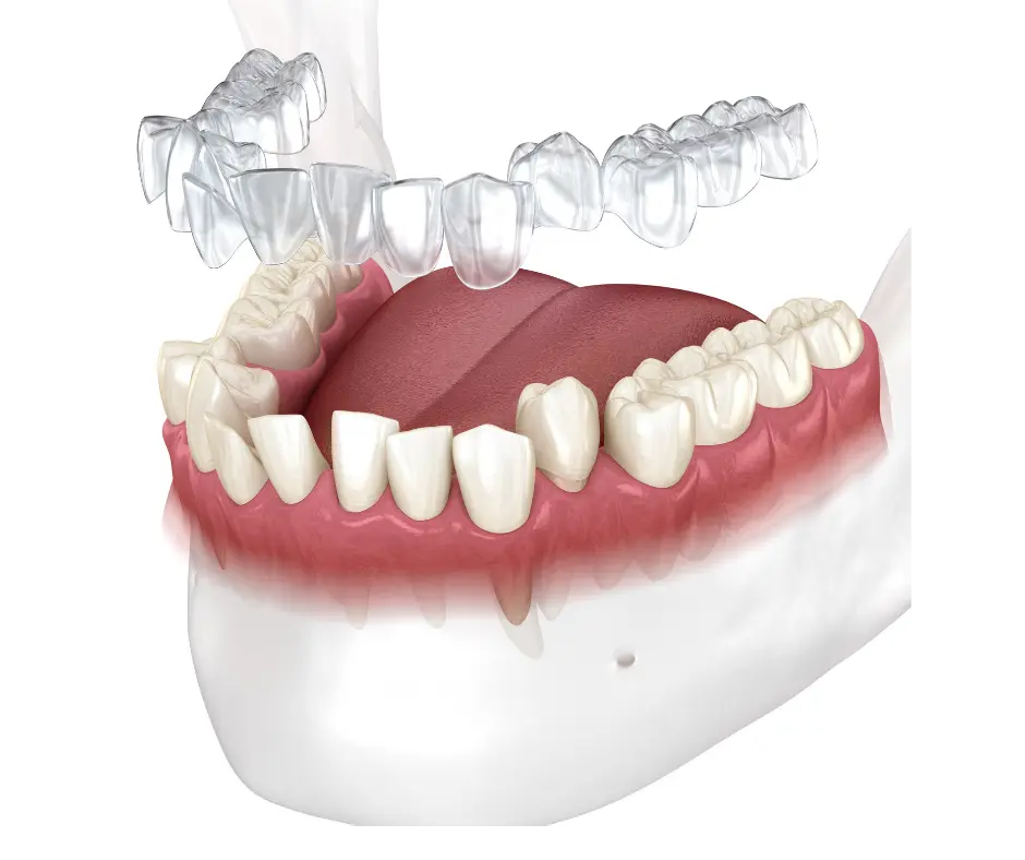 Set of clear aligner trays for orthodontic treatment