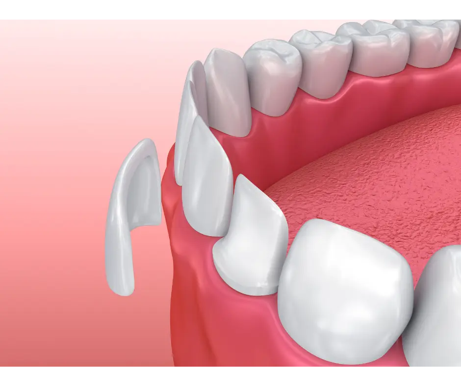 Close-up of porcelain veneers compared against a natural tooth shade