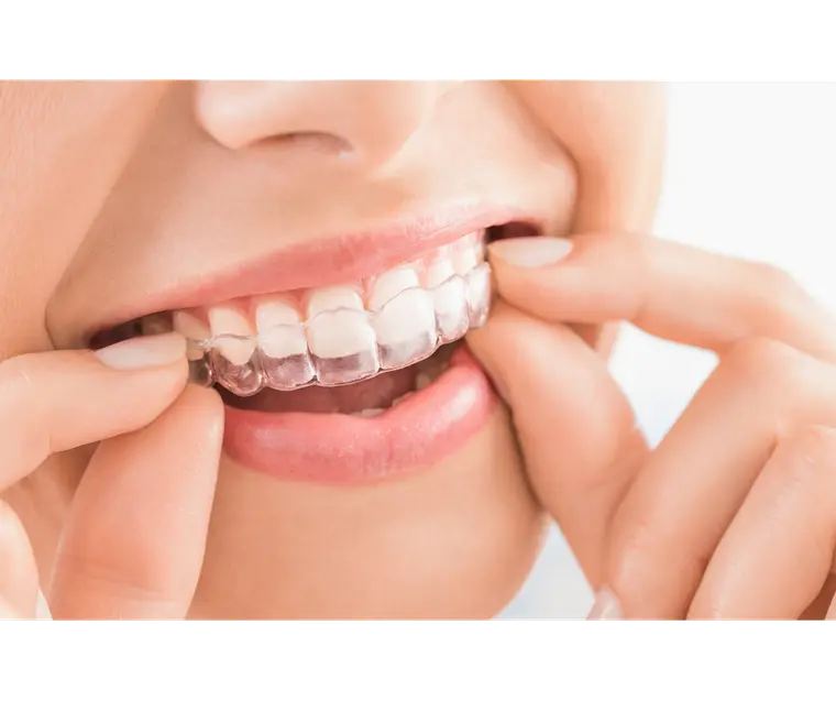 ClearCorrect clear aligners for straightening teeth