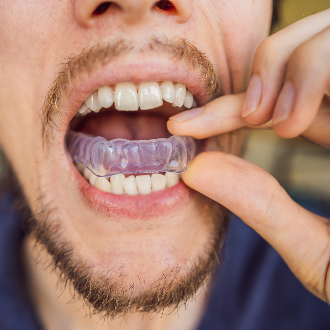 Nightguards at Valley Dental Turlock