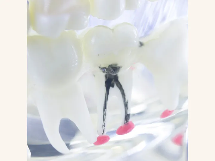 Root canal treatment to save an infected tooth at Valley Dental Turlock